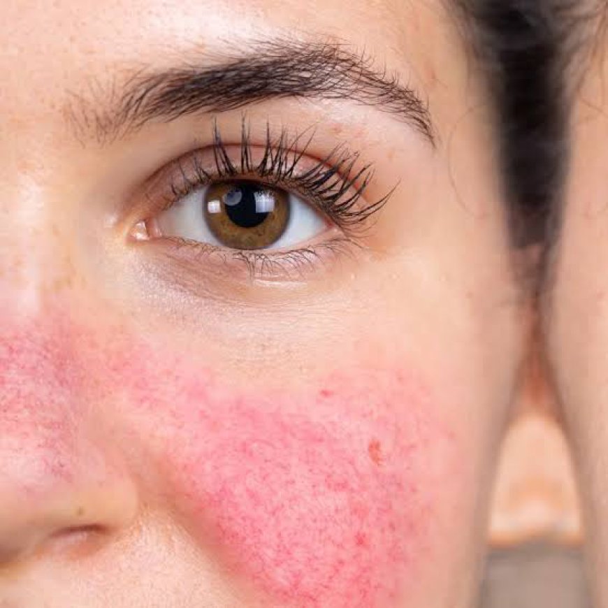 Can Rosacea Treatment Reduce Facial Redness?