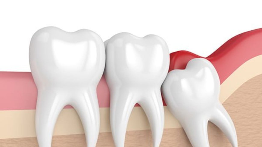 Upper Wisdom Tooth Removal in Bryn Mawr, PA