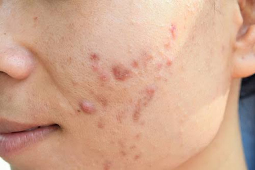 How Does Acne Treatment Help Improve Skin Clarity?