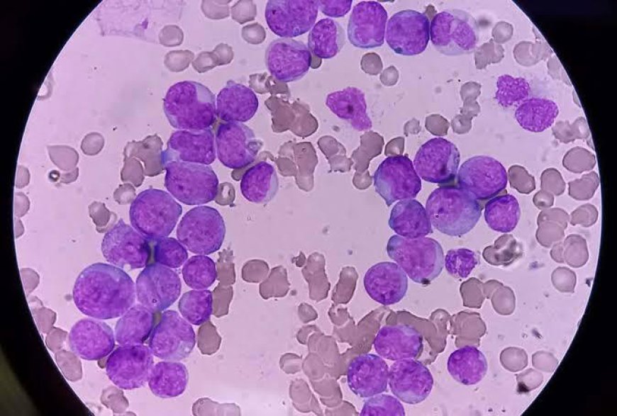 Acute Myeloid Leukemia (AML) Market Size, Trends, and Growth Opportunities 2026-2033