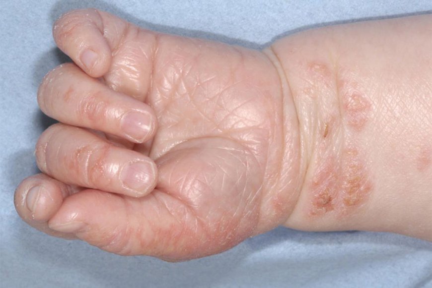 Can Children Develop Chronic Skin Disorders?