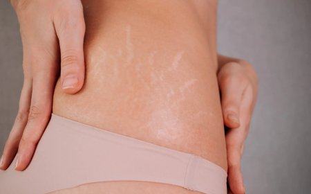 Why Choose Stretch Marks Removal?