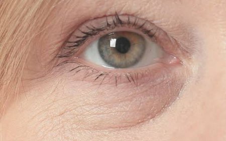 How Is Eye Bag Removal Treatment Performed?