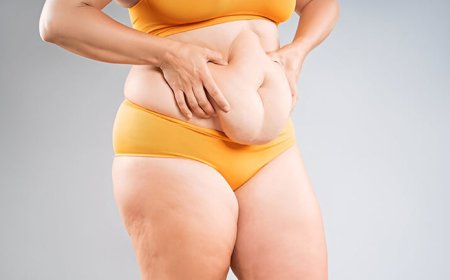 Tummy Tuck Surgery in Delhi - Dr Rajat Gupta