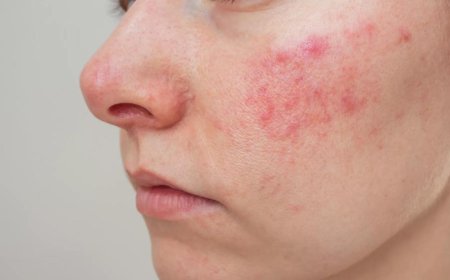 Can Rosacea Treatment Minimize Persistent Facial Redness?