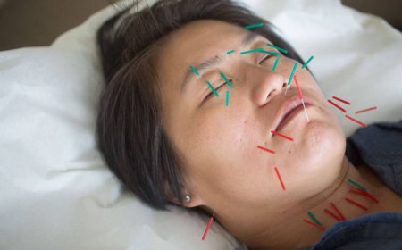 Facial Rejuvenation Acupuncture Before an Event: Timeline