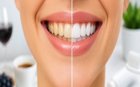 Foods and Drinks to Avoid After Teeth Whitening