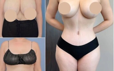 Tummy Tuck in Dubai: Precision Body Contouring Solutions