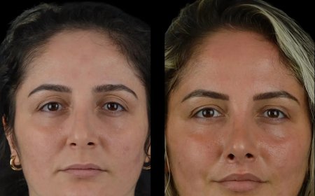 Expert Cheek Fillers Doctors at Best Aesthetic Clinics in dubai