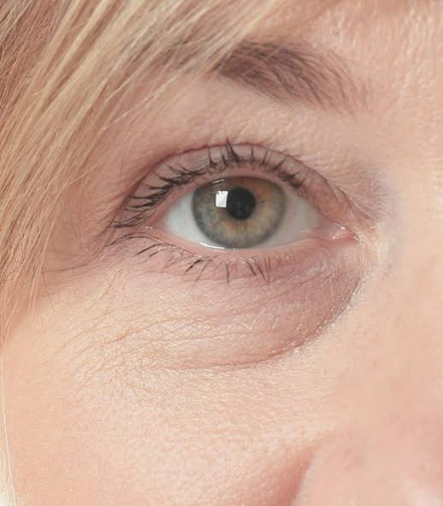 How Is Eye Bag Removal Treatment Performed?