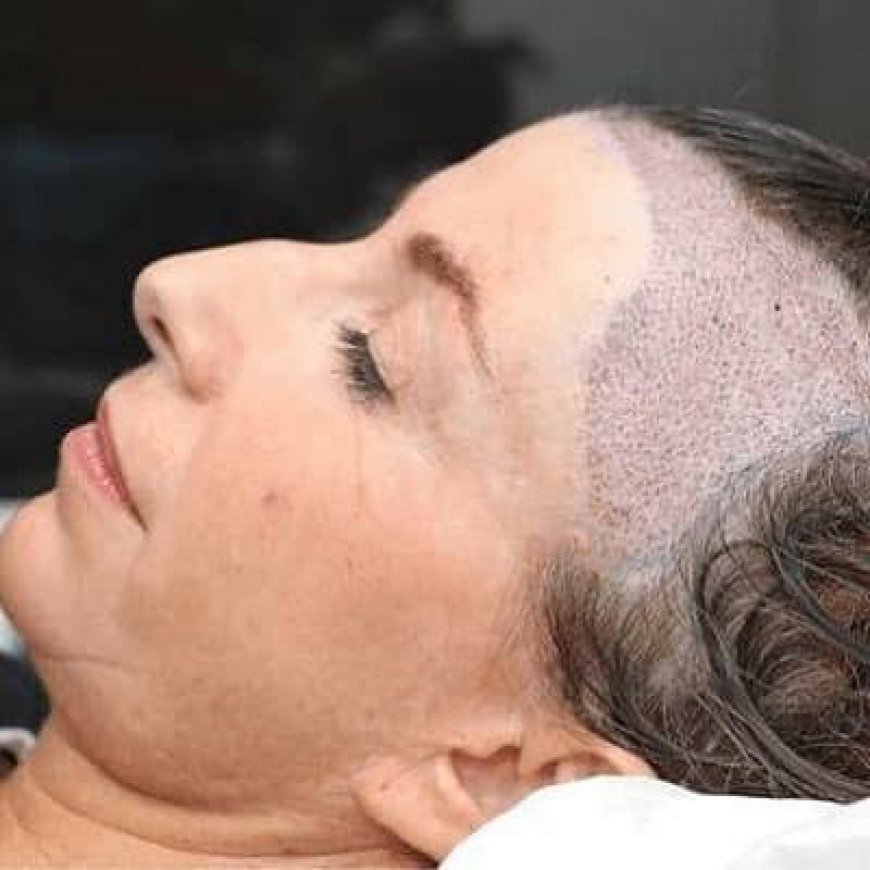 Can Female Hair Transplants Restore Thinning Hair?