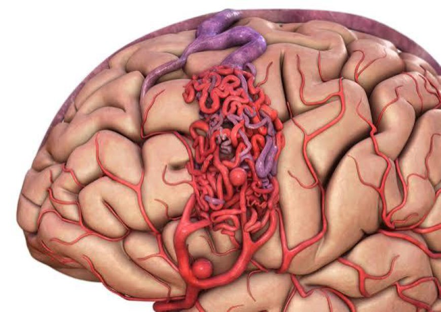 Arteriovenous Malformations Market: Size, Trends, and Strategic Growth Insights