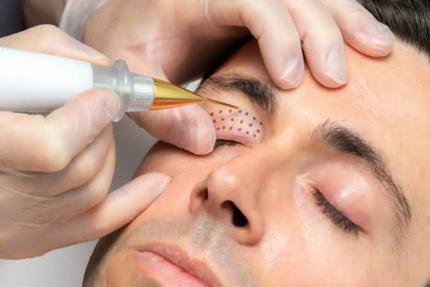 How Can Plexr Plasma Eye Lift Improve Eyelids?