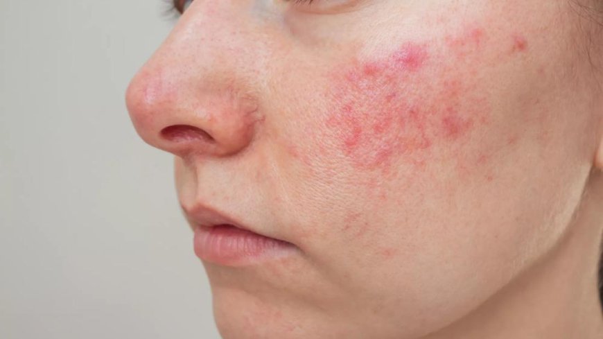 Can Rosacea Treatment Minimize Persistent Facial Redness?
