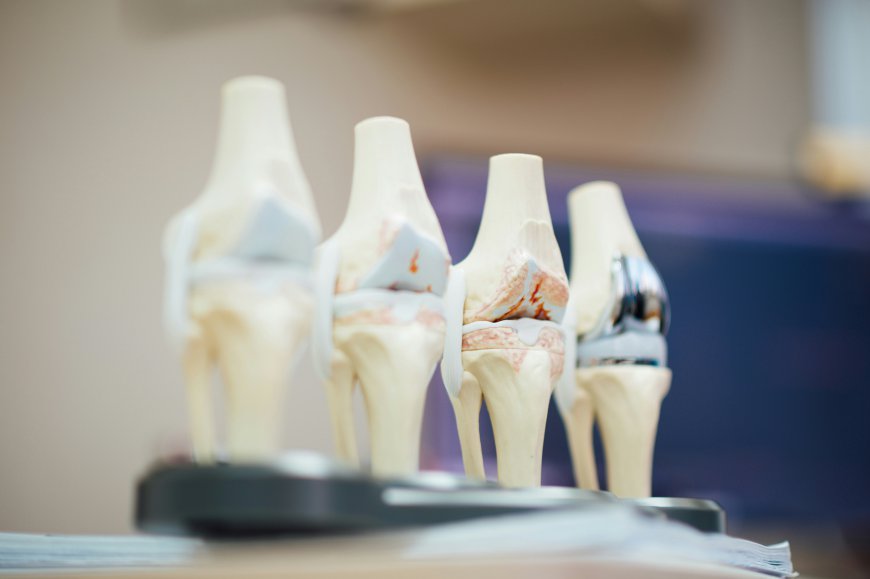 Knee Implants Market Size, Trends, and Growth Forecast 2026-2033