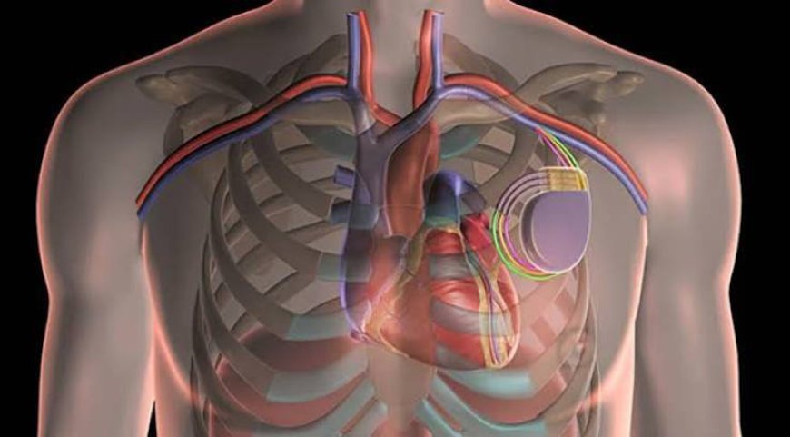 Global Cardiac Resynchronization Therapy Market Size, Trends, and Growth Outlook 2026-2033