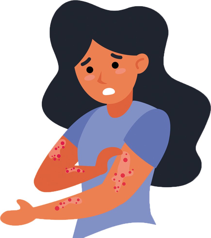 Plaque Psoriasis Market Size, Trends, and Growth Forecast 2026-2033