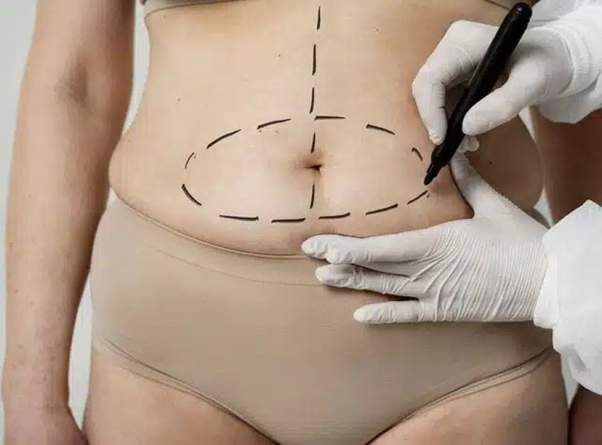 Why International Patients Choose a Tummy Tuck in Dubai