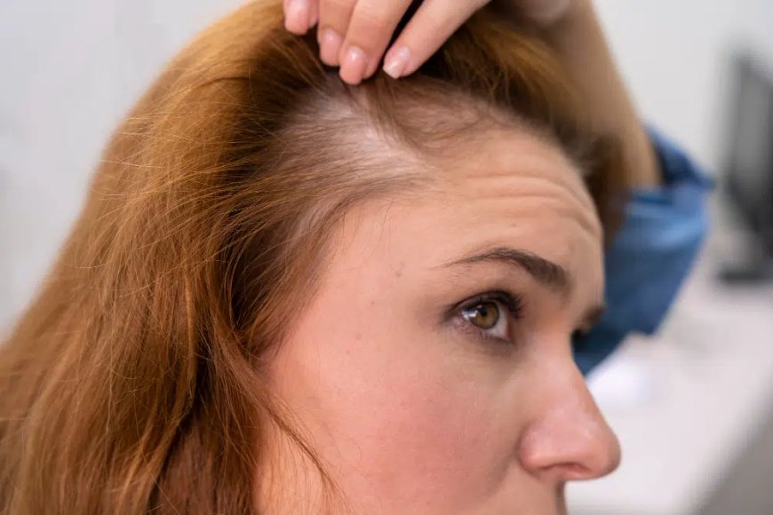 Who Is a Good Candidate for Female Hair Transplants?