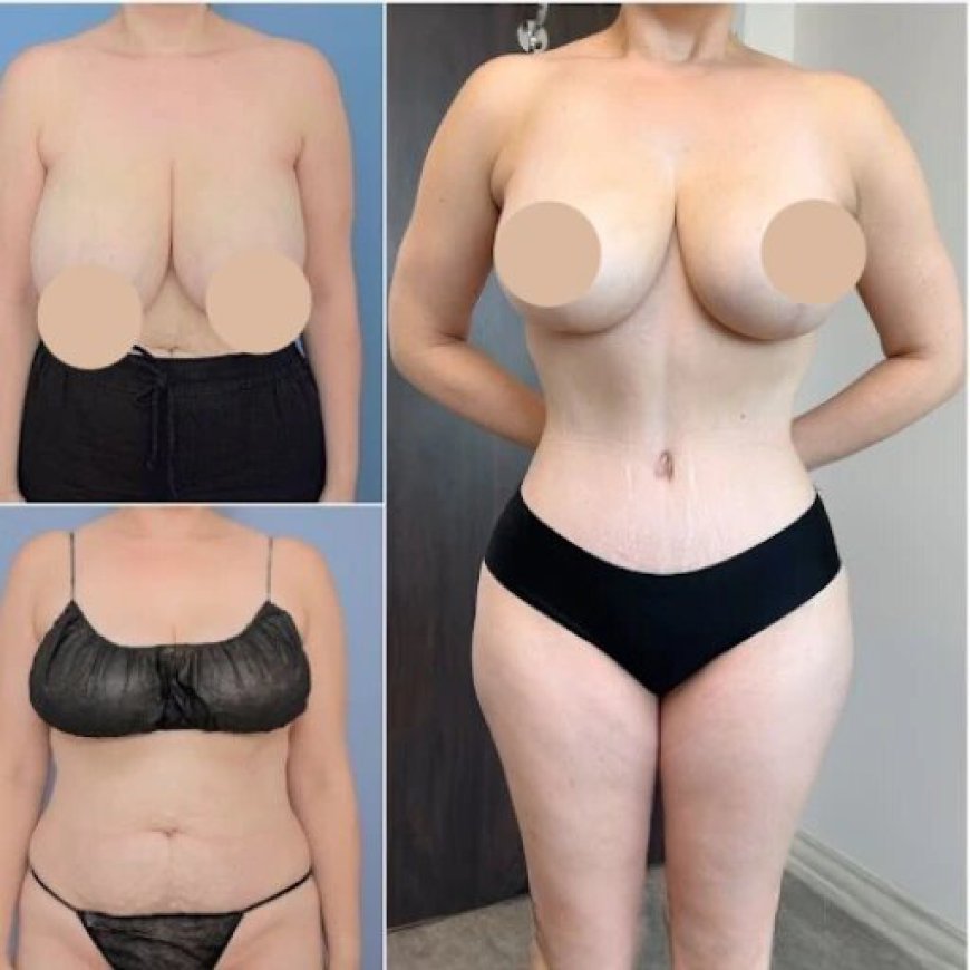 Tummy Tuck in Dubai: Precision Body Contouring Solutions