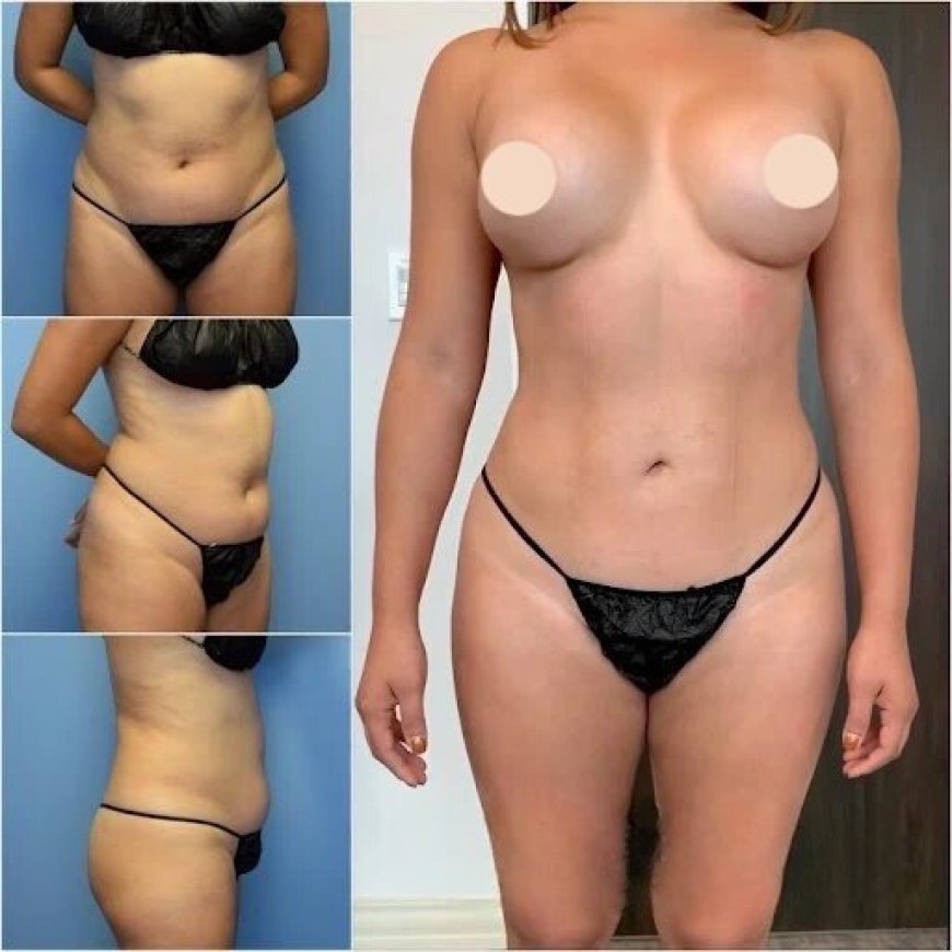Body Contouring in Dubai: Expert Tips for Beautiful Body Proportions