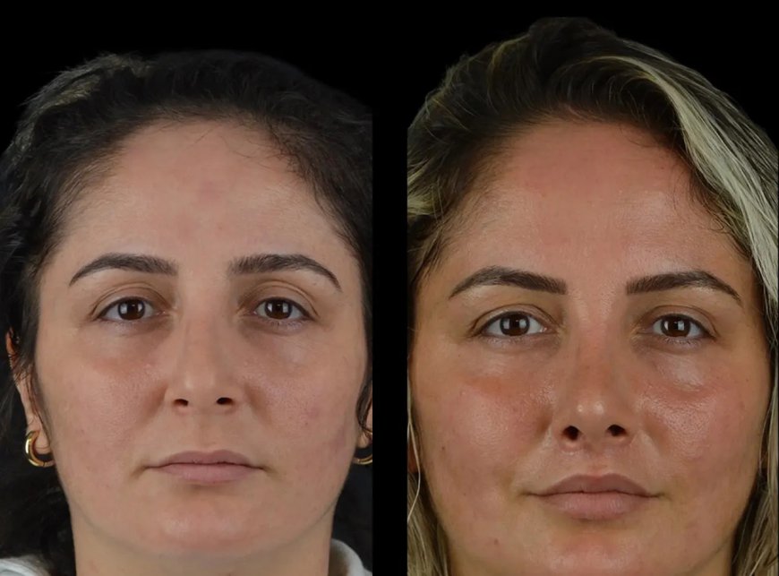 Expert Cheek Fillers Doctors at Best Aesthetic Clinics in dubai