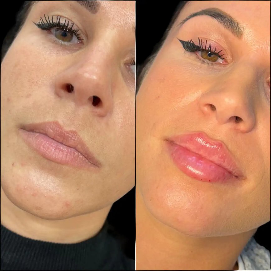Best Aesthetic Clinics in Dubai for Personalized Beauty Fillers Enhancement