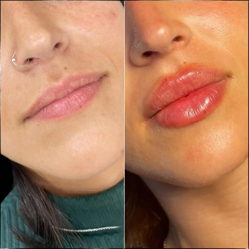 Dermal Fillers for Healthy Looking Skin Best Aesthetic Clinics in dubai