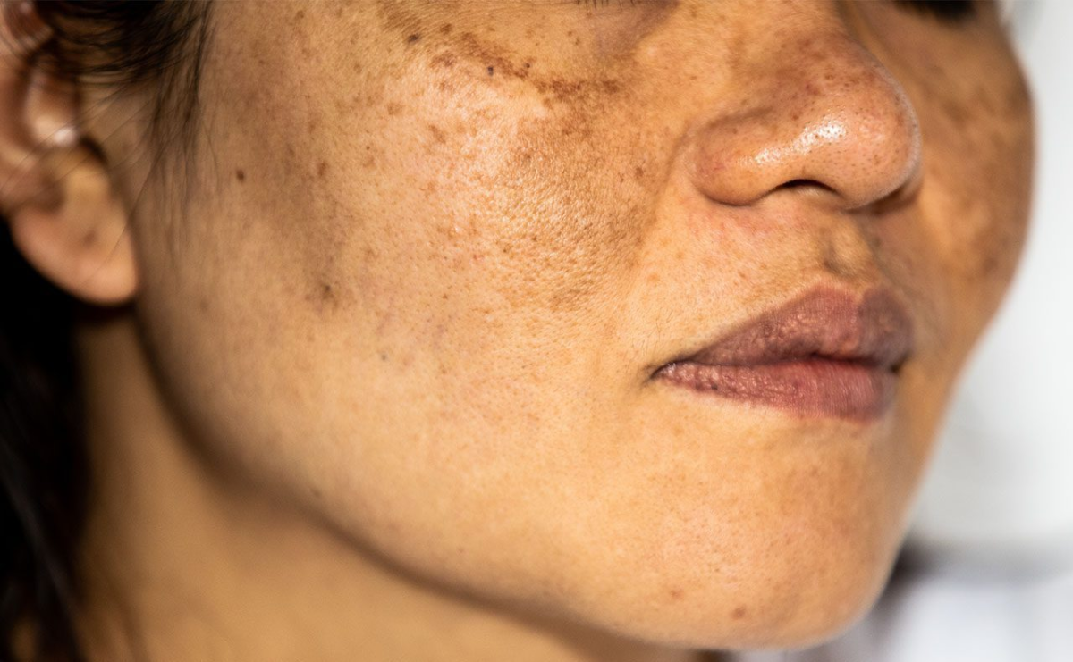 Myths and Facts About Best Pigmentation Treatment