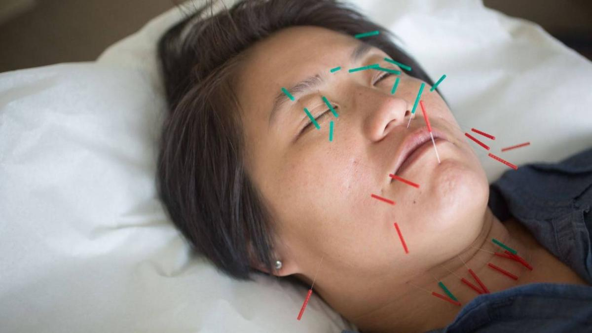 Facial Rejuvenation Acupuncture for Jawline & Neck | Oakland