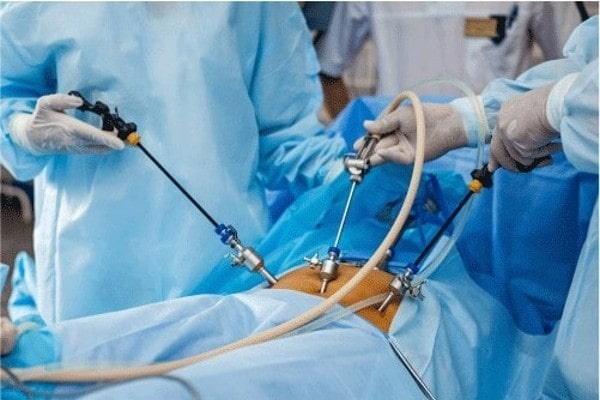 Digestive Ease After Endoscopic Balloon Extraction