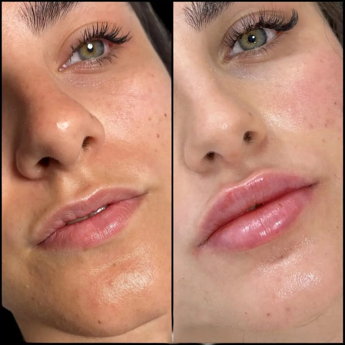 Fillers in Dubai for Natural Volume and Definition