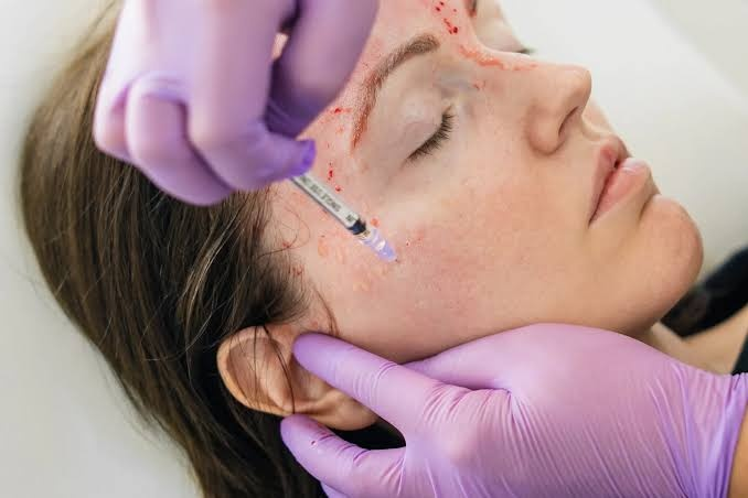Rough Texture Issues? Vampire Facial Smooths Skin Deeply