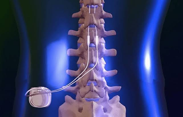 Spinal Cord Stimulators Market Size, Trends, and Growth Forecast 2026–2033