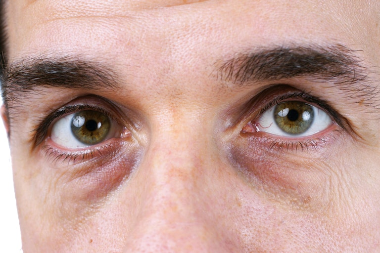 How Do You Maintain Dark Circles Treatment Results?