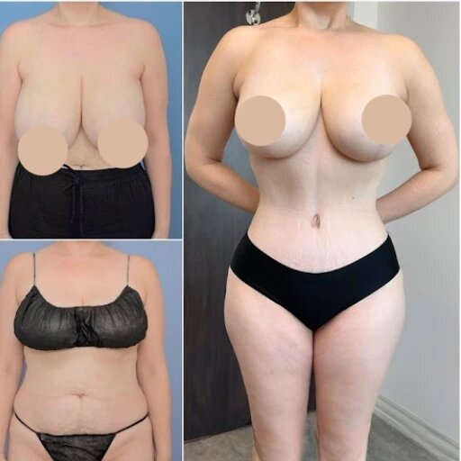 Best Doctors in Dubai for Tummy Tuck to Reclaim Your Figure