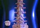 Spinal Cord Stimulators Market Size, Trends, and Growth Forecast 2026–2033