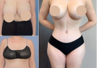 Best Doctors in Dubai for Tummy Tuck to Reclaim Your Figure