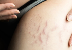 How to Begin Your Stretch Marks Removal Journey