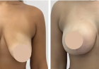 Best Doctors in Dubai for Breast Reduction and Beautifully Balanced Body Contours