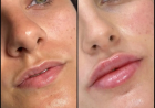 Fillers in Dubai for Natural Volume and Definition