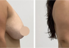 Best Doctors in Dubai for Breast Lift and Customized Solutions for Improved Breast Firmness