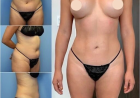 Best Doctors in Dubai for Body Contouring and Enhanced Body Proportions