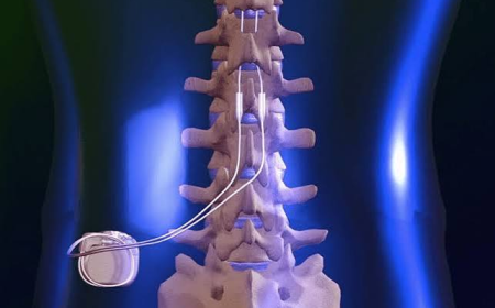 Spinal Cord Stimulators Market Size, Trends, and Growth Forecast 2026–2033