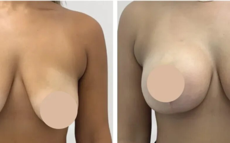Best Doctors in Dubai for Breast Reduction and Beautifully Balanced Body Contours