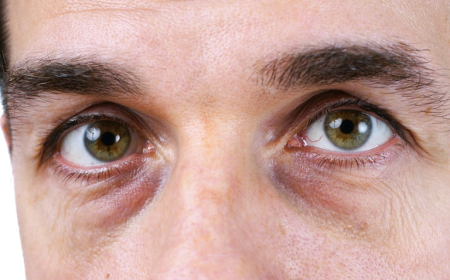 How Do You Maintain Dark Circles Treatment Results?