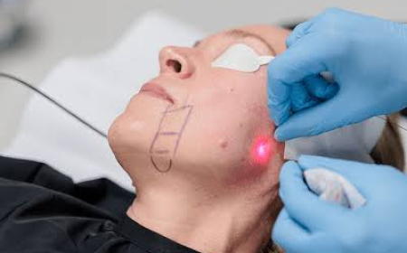 Non-surgical Face Lifting In Dubai: Lift Without Surgery