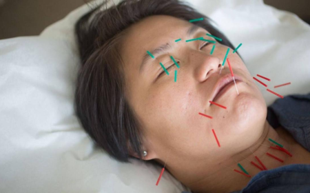 Facial Rejuvenation Acupuncture for Jawline & Neck | Oakland