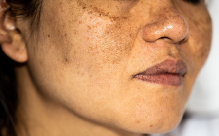 Myths and Facts About Best Pigmentation Treatment