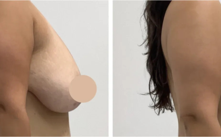 Best Doctors in Dubai for Breast Lift and Customized Solutions for Improved Breast Firmness